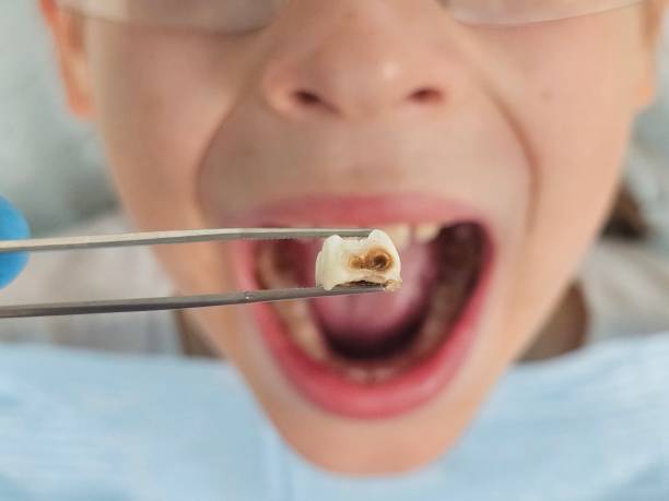 Best Chipped Tooth Repair Near Me  in Los Alamos, CA